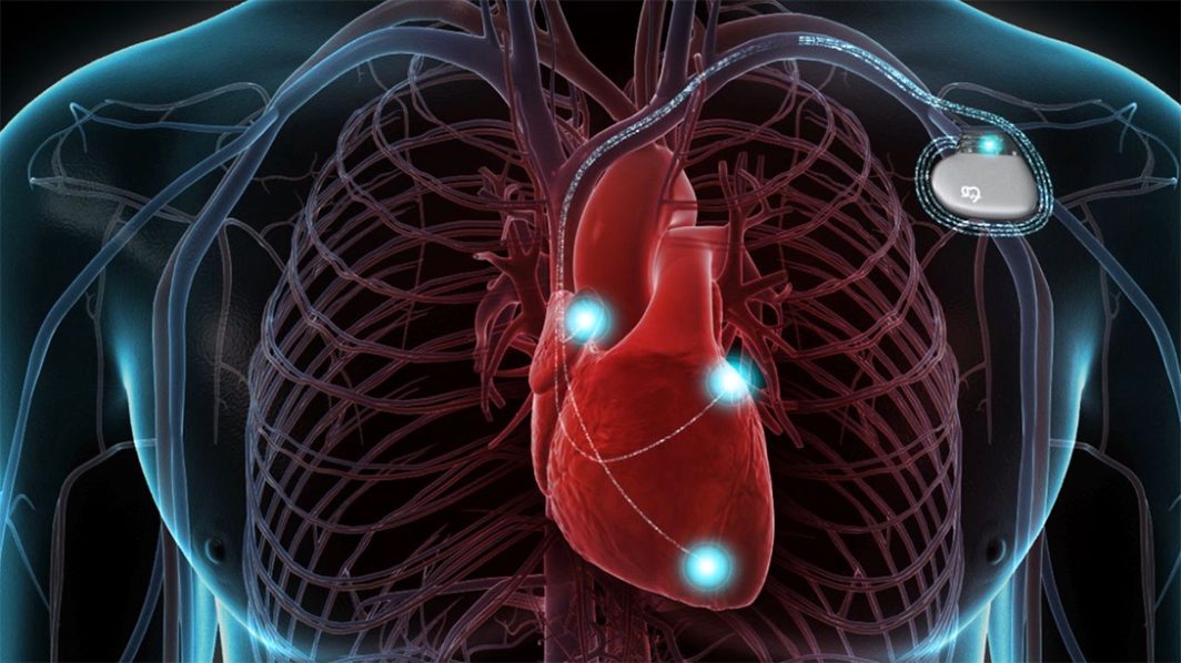 Guidant Corporation Recalls Heart Defibrillators