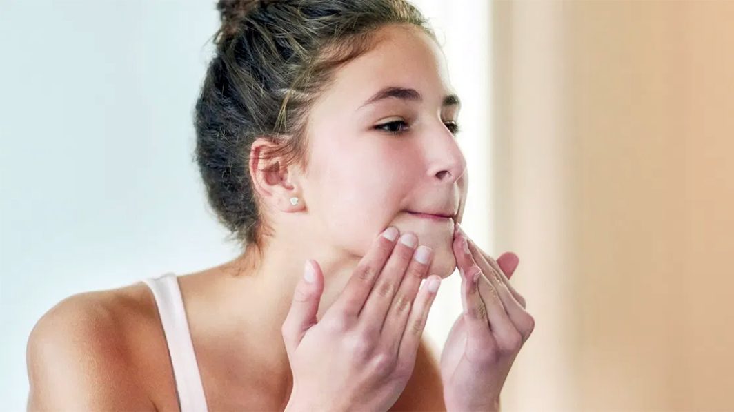 A Natural Approach To Managing Acne