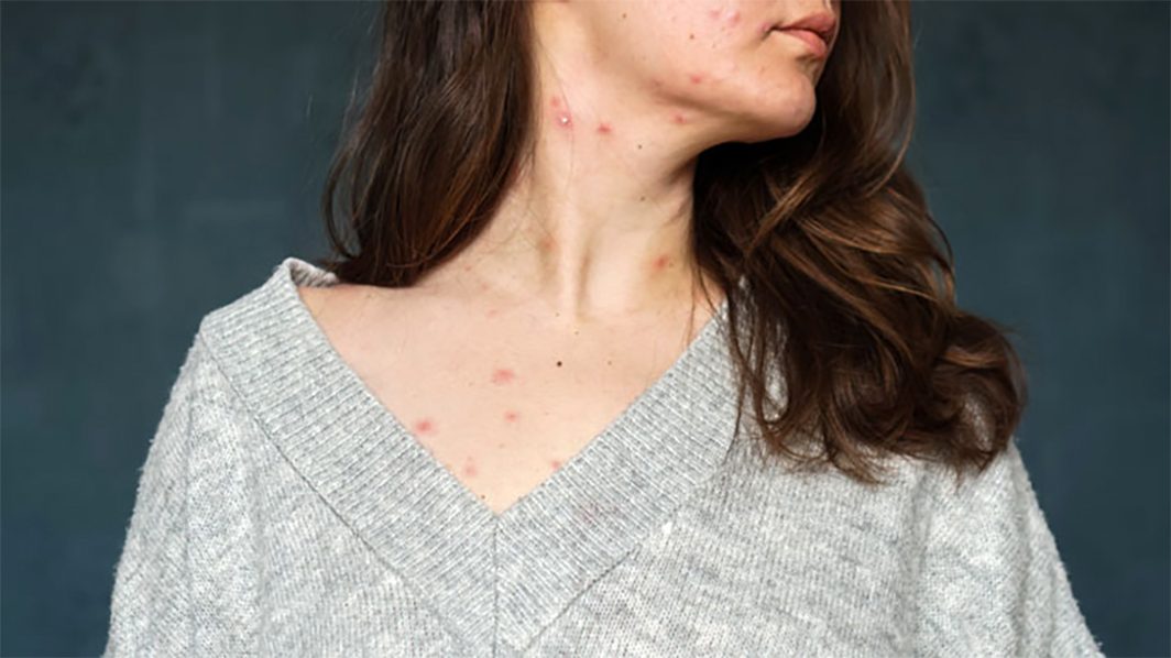 Treat Chickenpox with natural remedies, herbs and nutrients