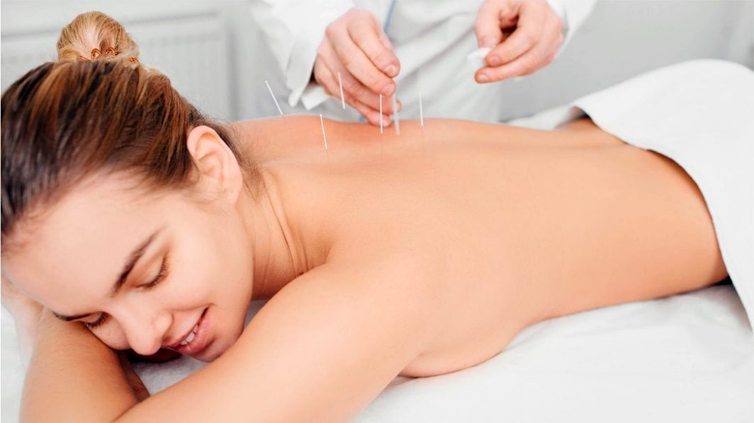 6 Steps to Finding the Best Acupuncturist For You