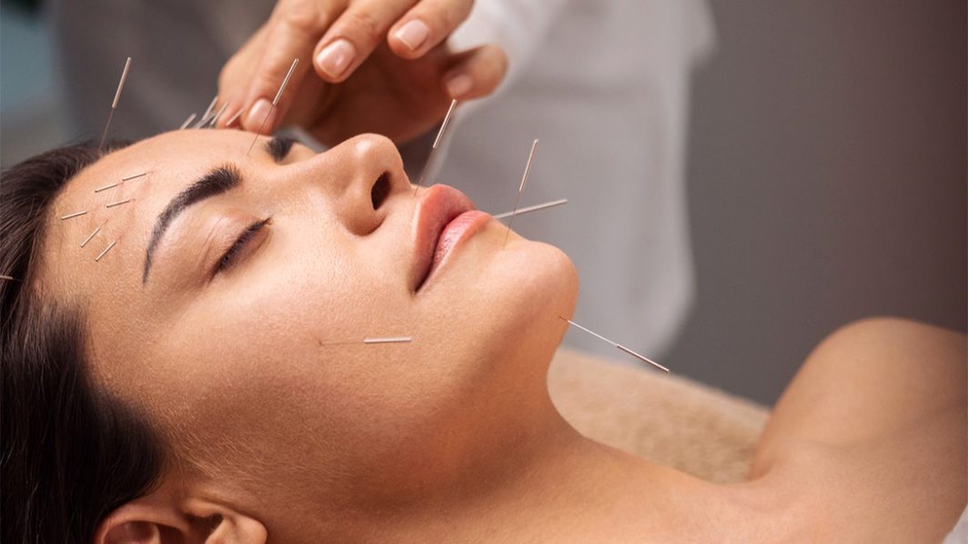Acupuncture: Questions and Answers with an Expert