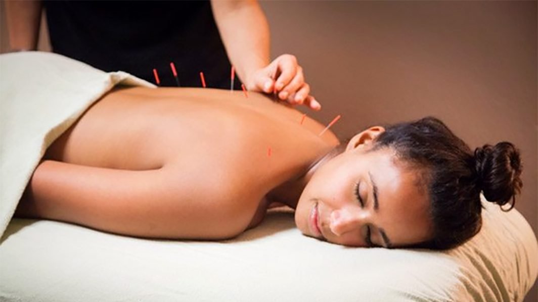 Acupuncture Weight Loss with 5 Step Plan
