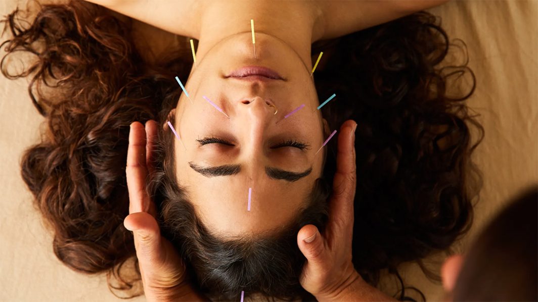 Acupuncture and Pain Relief