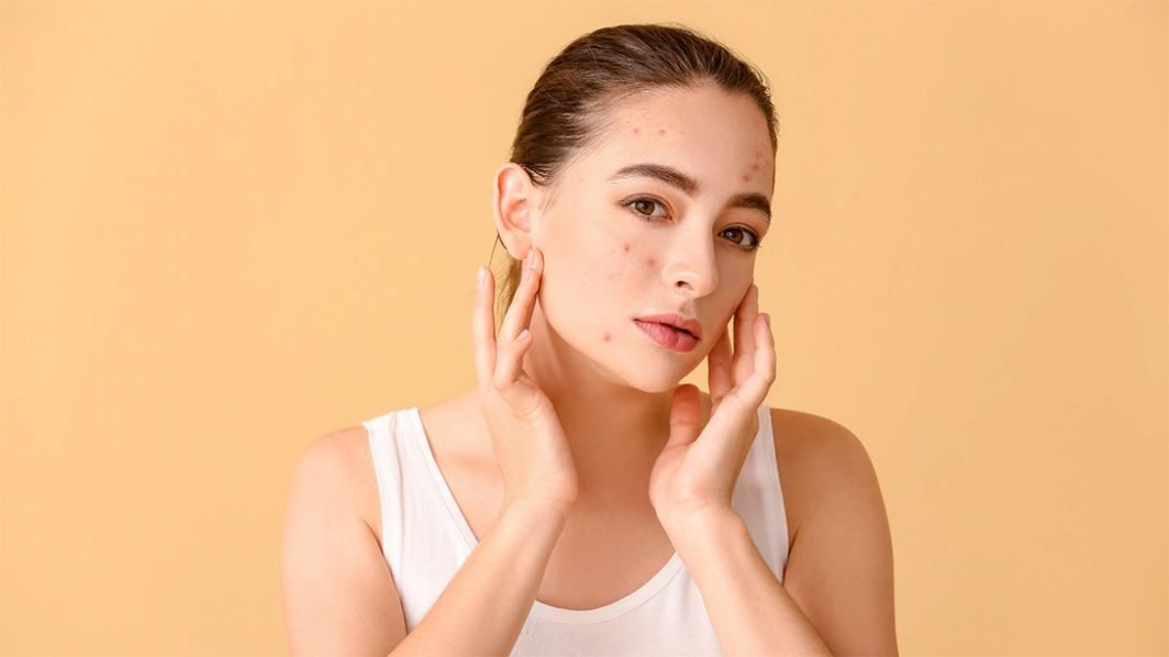 Down with Acne!