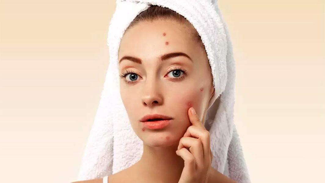 New Discovery May Lead To More Effective Acne Treatments