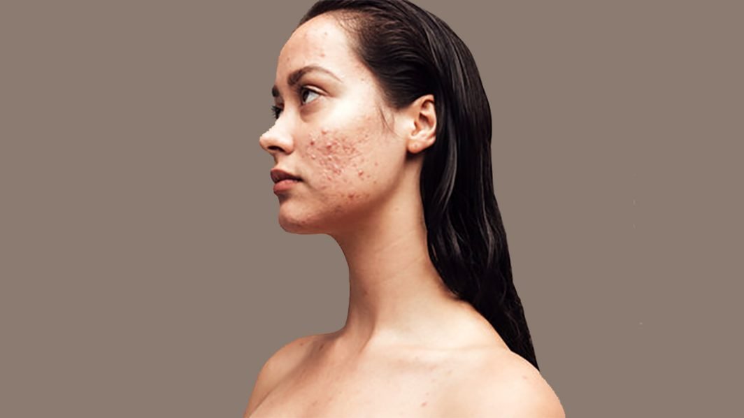 Shopping for Sensitive Skin: A Guide for the Acne and Rosacea Conscious