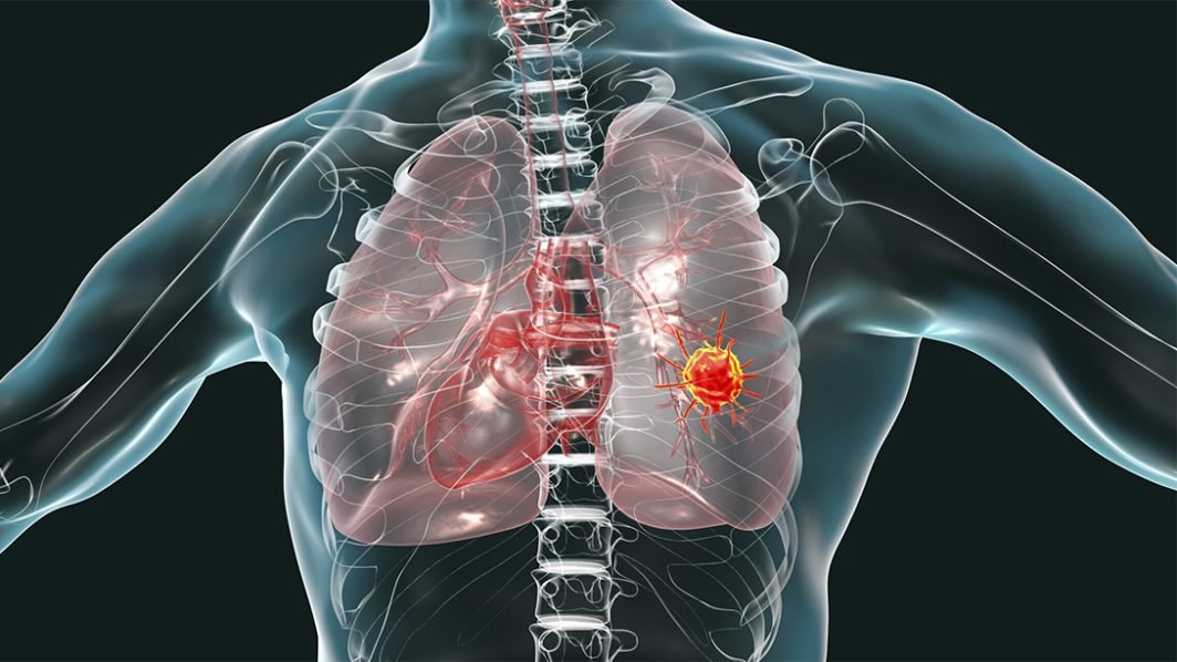Mesothelioma Cancer