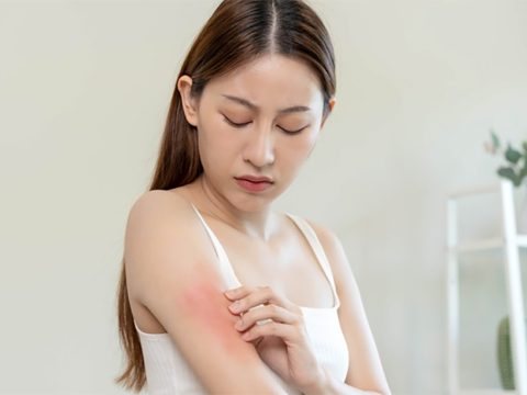 Natural Prescription for Eczema