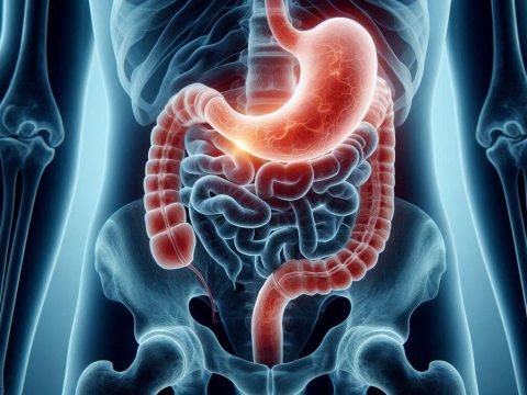 Stomach Ulcers